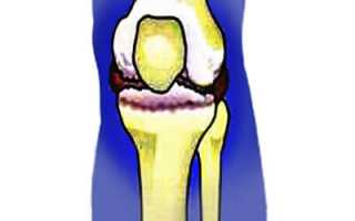 Причины боли в коленной чашечке, способы лечения и диагностики