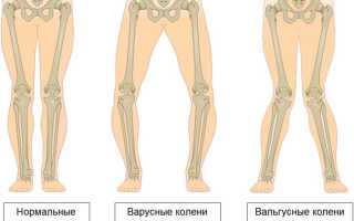 Деформация коленных суставов: виды и лечение