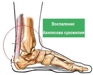 воспаление ахилова сухожилия