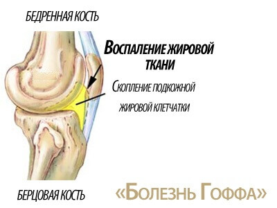 Болезнь Гоффа