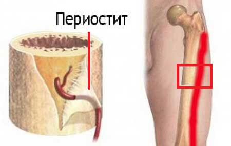 периостит голени