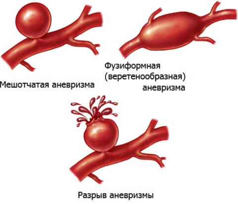 аневризма артерии