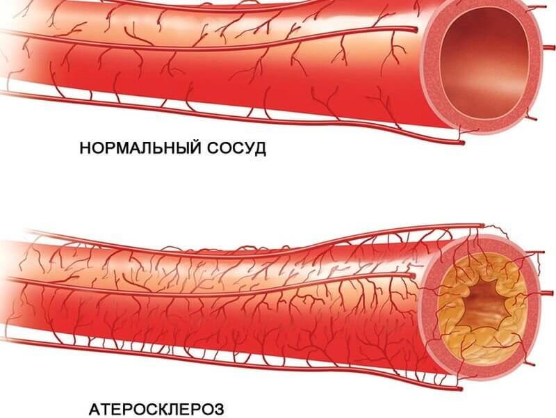 атеросклероз