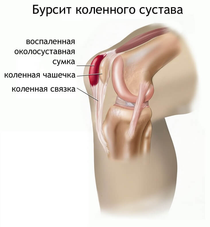 бурсит