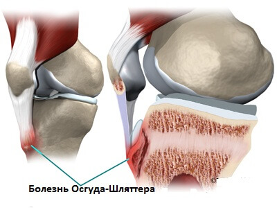 на фото изображена болезнь Осгуда-Шляттера 