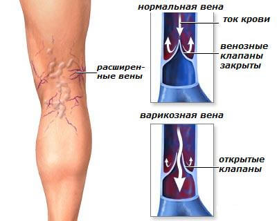 варикоз